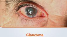 Why Glaucoma Being Called The Silent Thief?