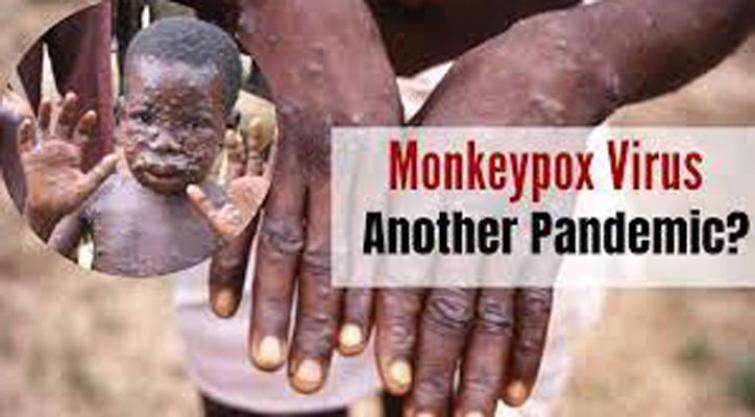 Monkeypox: Cases reported in US, UK, parts of Europe