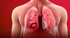 World Lung Cancer Day 2025: Tests that can help check the functioning
