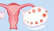 Irregular periods in teenagers