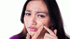 Adult acne is rising in India and stress may be the biggest trigger