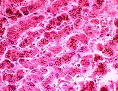 Bile pigment could stave off cancer, heart disease