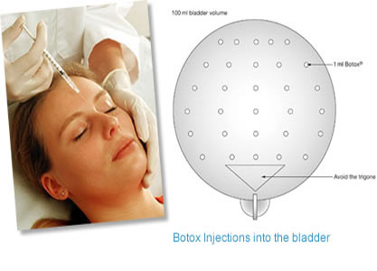 Botox bladder injections may stop the 'gotta-go' urge in women