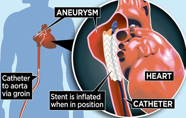 A burst arota means death or major operation, but repairing an AAA, saves 3000 men a year
