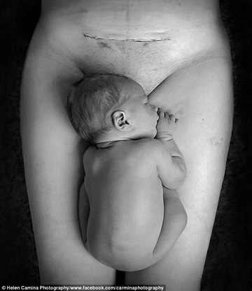 Helen Aller's C-section scar photo of a mother with her newborn goes viral