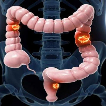 Doctors stress on need to know colorectal cancer symptoms
