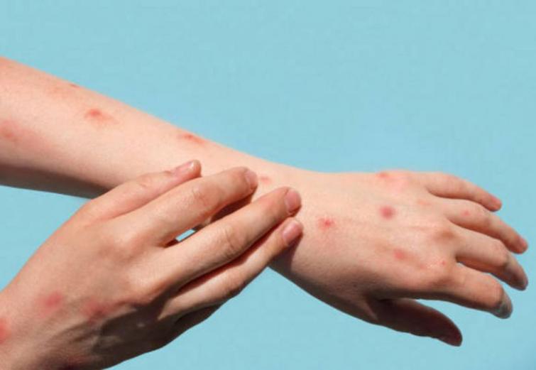 Monkeypox confirmed cases rise to 1,600: WHO
