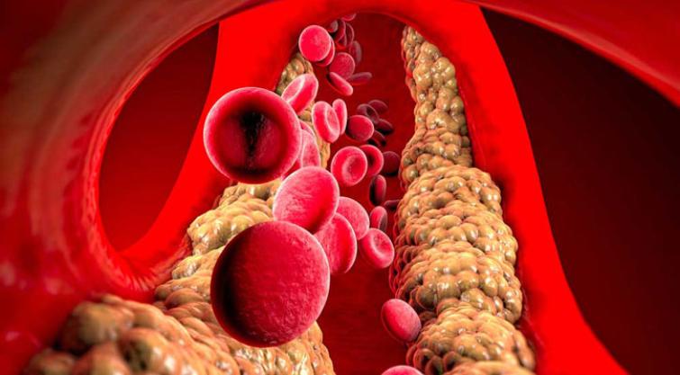 What happens to your body when you have high triglyceride