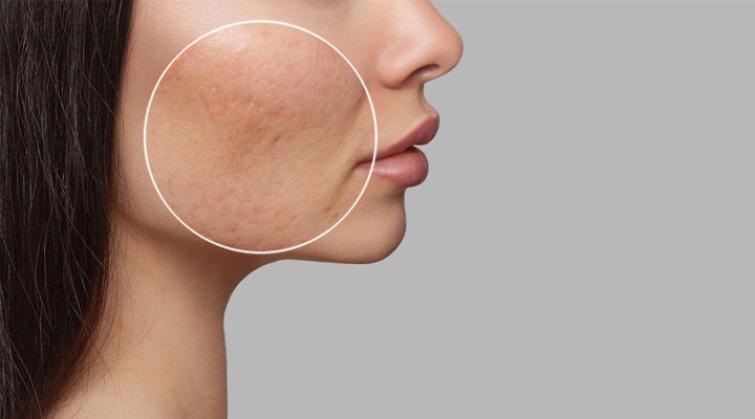 Breakouts on the rise due to pollution? 